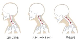 ストレートネックの図説