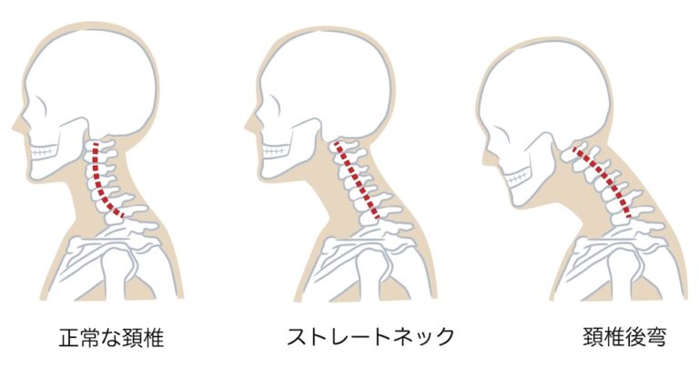 ストレートネックの図説