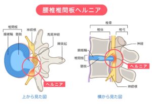 腰椎椎間板ヘルニア 椎間板の構造 腰痛